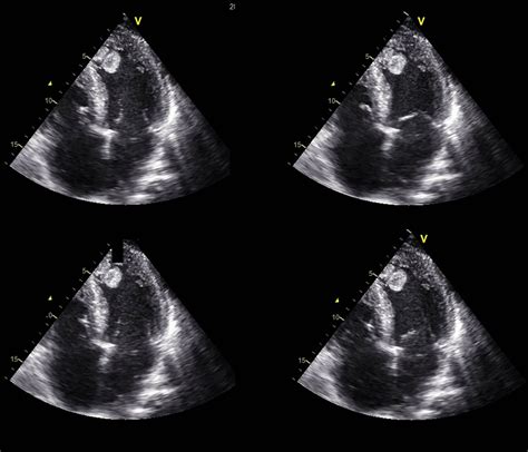 lv thrombus echo|left ventricular thrombus after infarction.